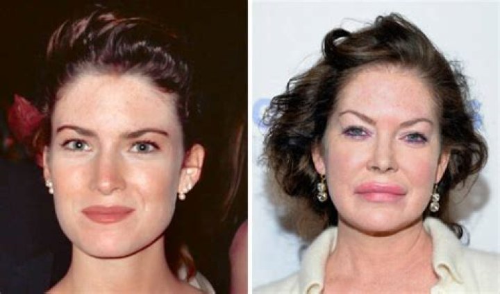 Photos Stars Who’ve Admitted To Plastic Surgery – Hollywood Life